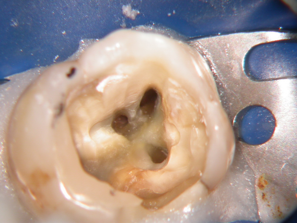 trepanierter Molar mit dargestellten Kanaleingängen unter Kofferdam